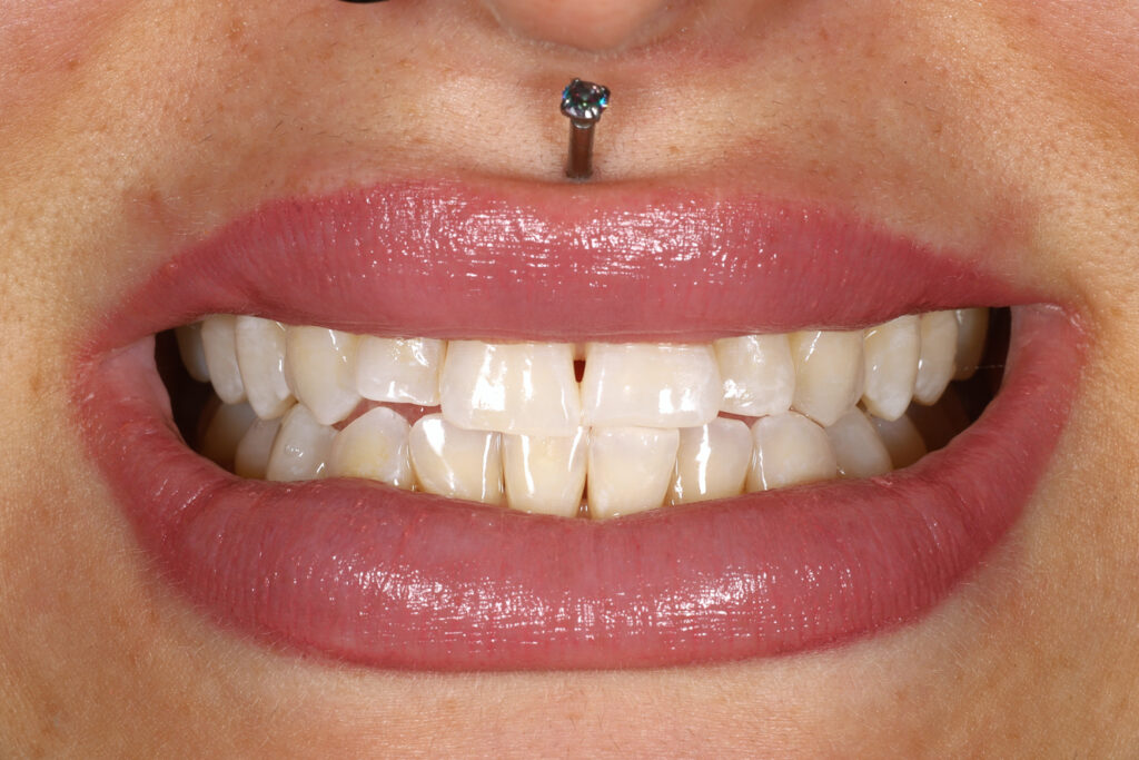Teeth after whitening