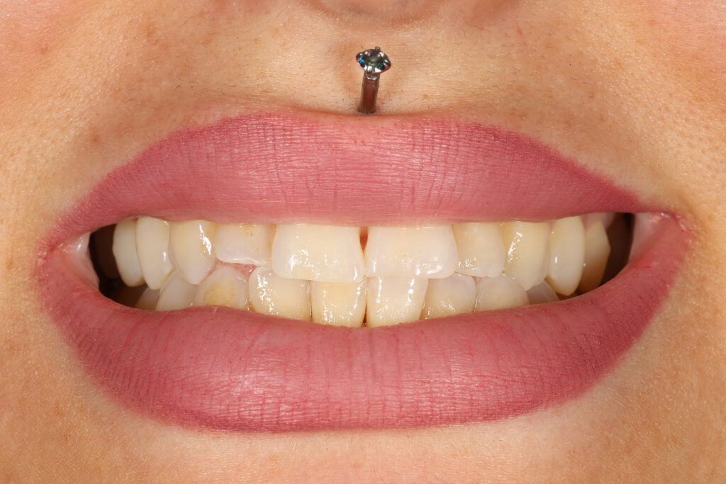 The same smile before whitening