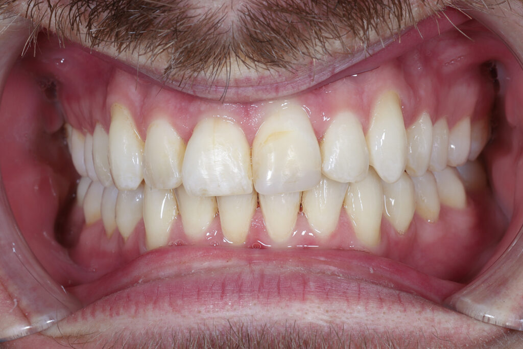 The same smile before whitening